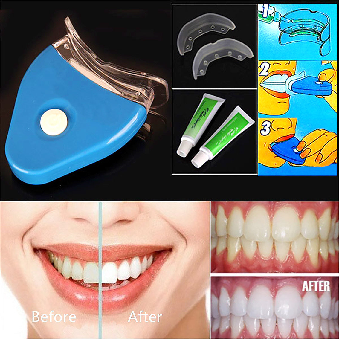 Professional Teeth Whitening Kit with LED Light - At-Home Dental Bleaching System